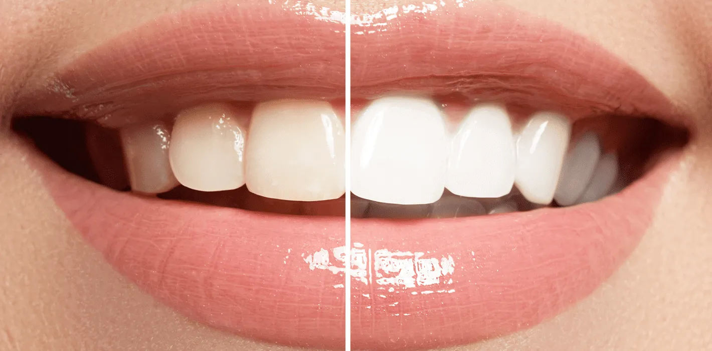 A picture showing how much teeth whitening can improve your aesthetics.