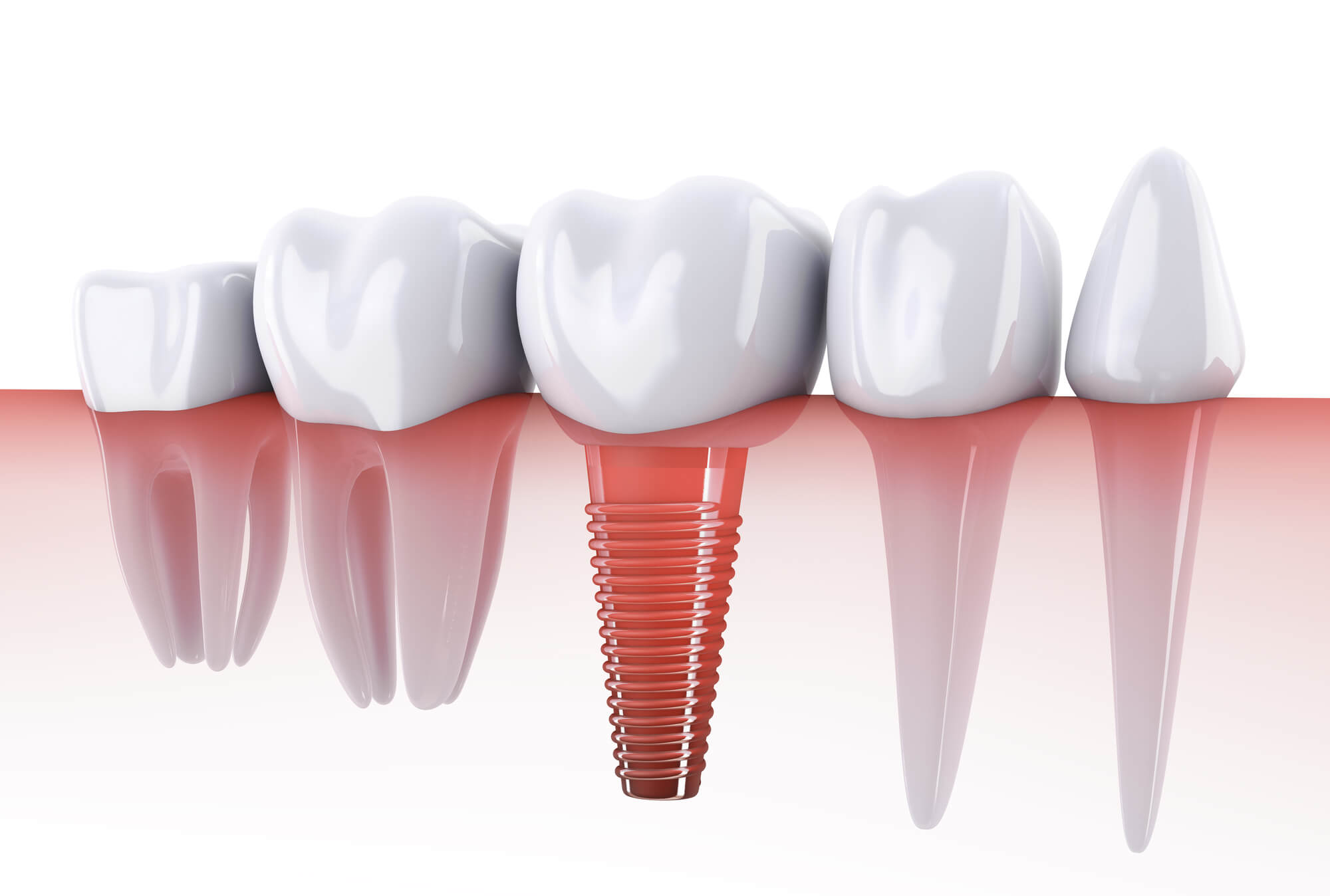3D render of affordable dental implants in las vegas