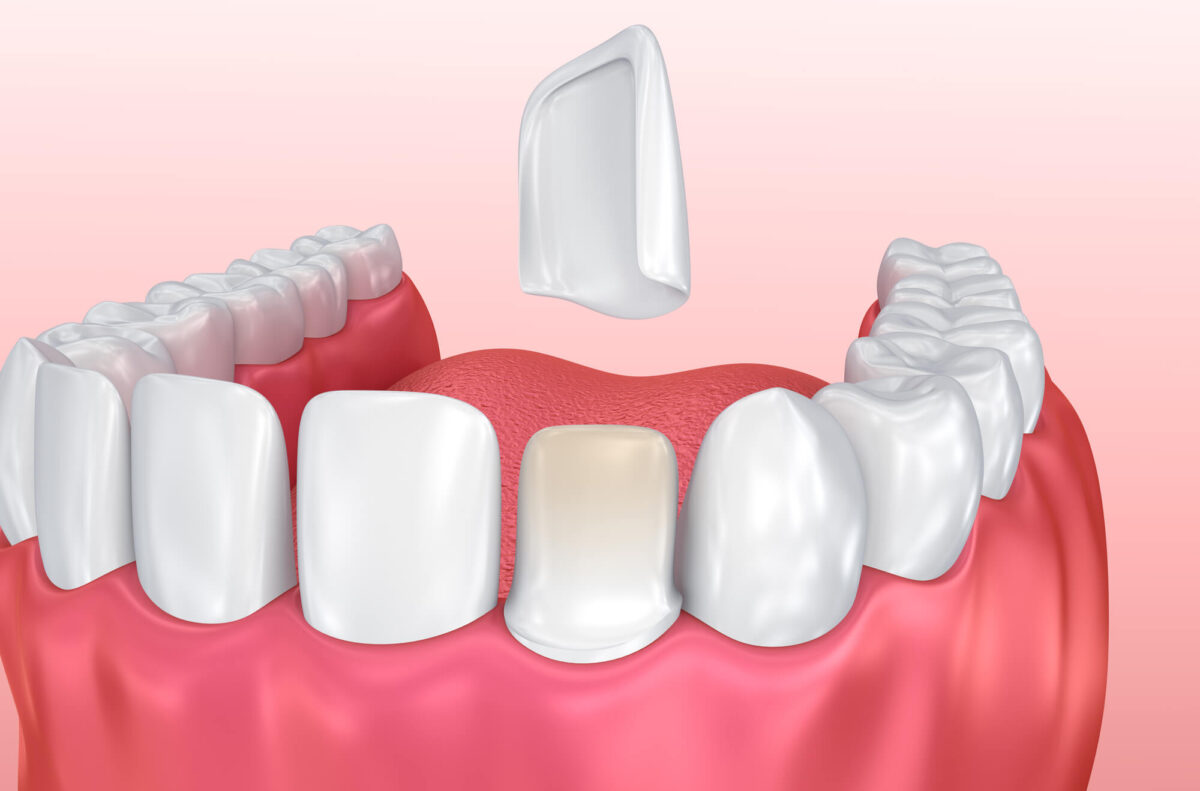An illustration showingteeth whitening in Las Vegas NV