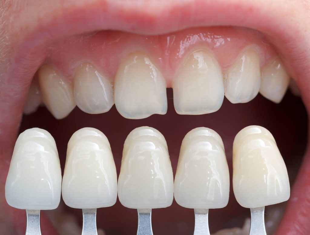 Close up of a person's teeth after getting teeth whitening in Las Vegas NV