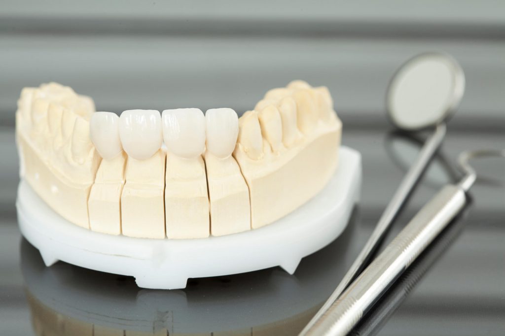 3D model of a teeth with dental crowns by a prosthodontist in Las Vegas