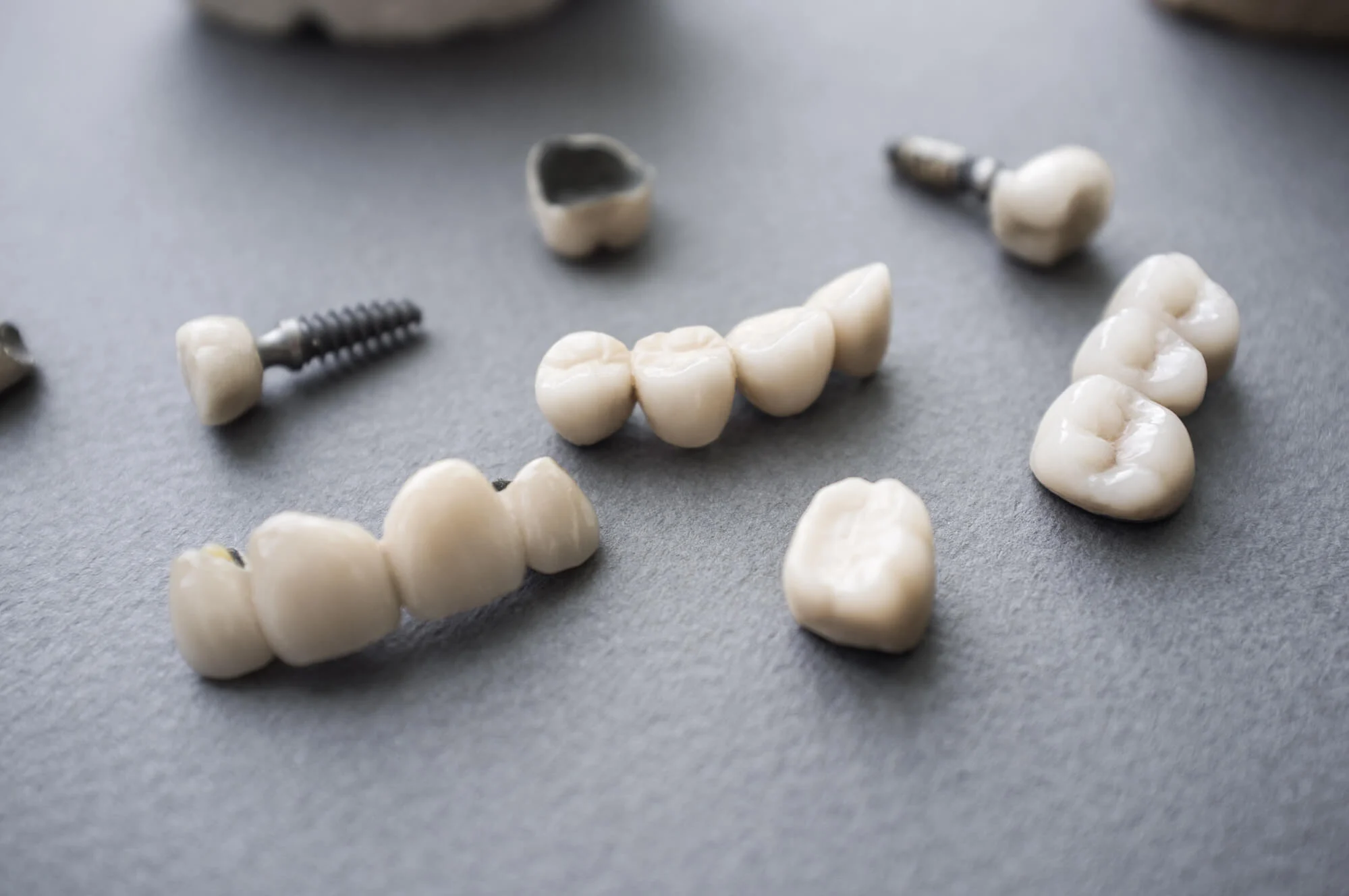 dental crowns owned by a prosthodontist in Las Vegas