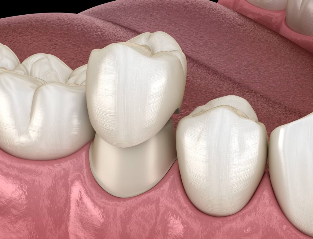 digital image of dental crown by a prosthodontist in Las Vegas