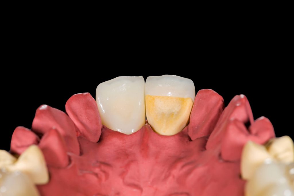 dental crown on a tooth made by a prosthodontist in Las Vegas