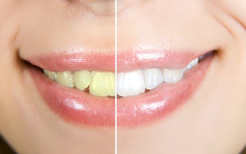 Depiction of the benefit of teeth whitening.