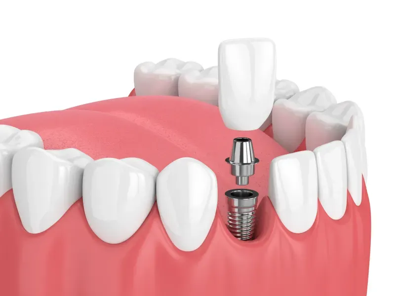dental-implant-p-800