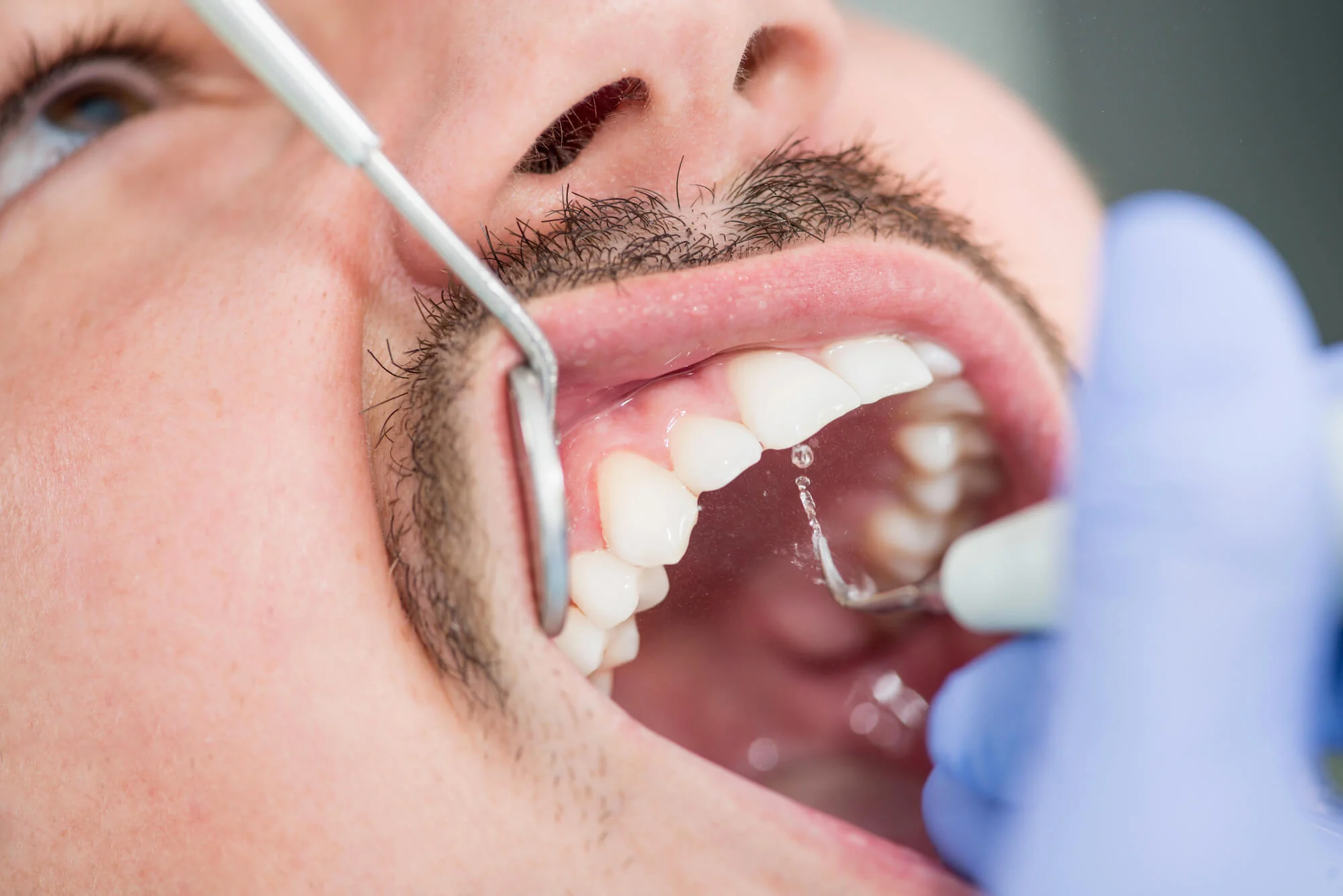 general dentist las vegas cleans patient's teeth