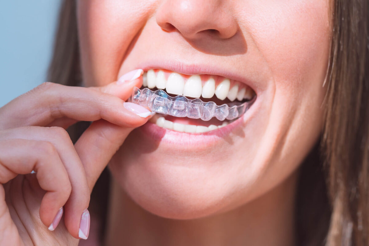 Clear Aligners vs. Traditional Braces: Making the Right Choice
