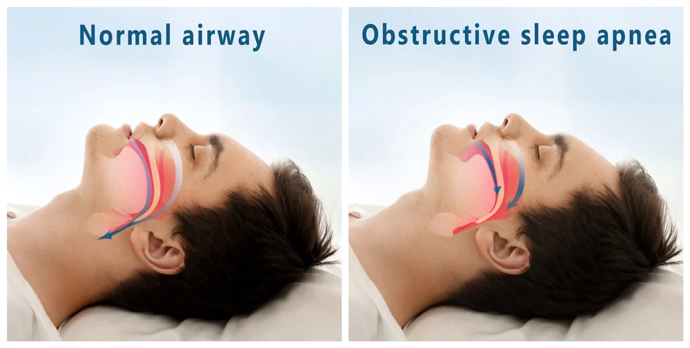 Normal vs sleep apnea airways.