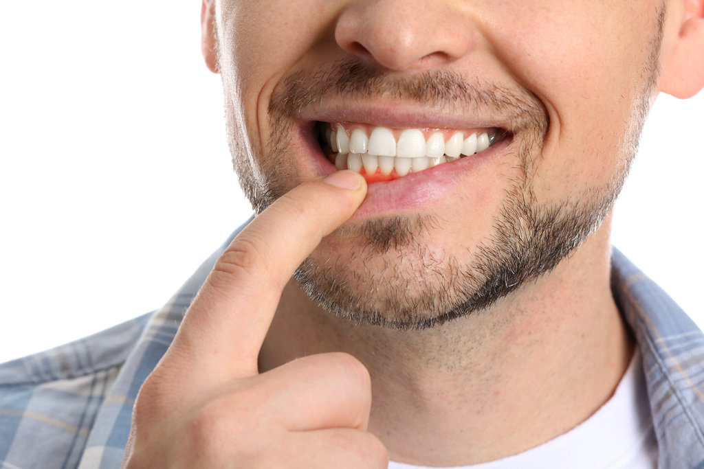 Man with gum inflammation on white background, closeup