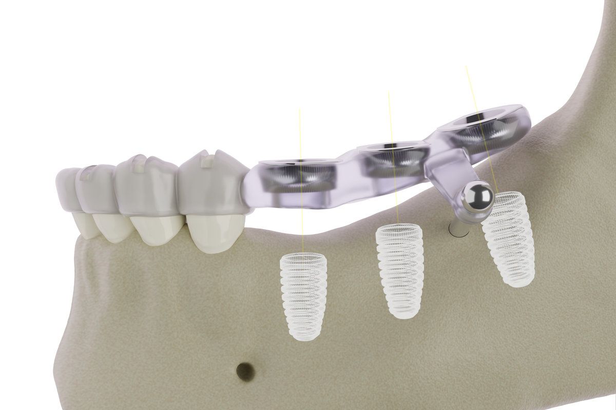 Surgical guide